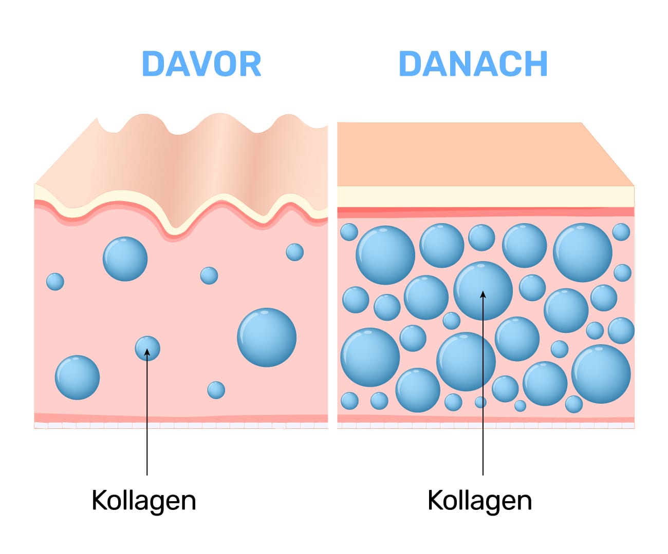 Haut davor und danach: wenig und viel Kollagen im Gewebe